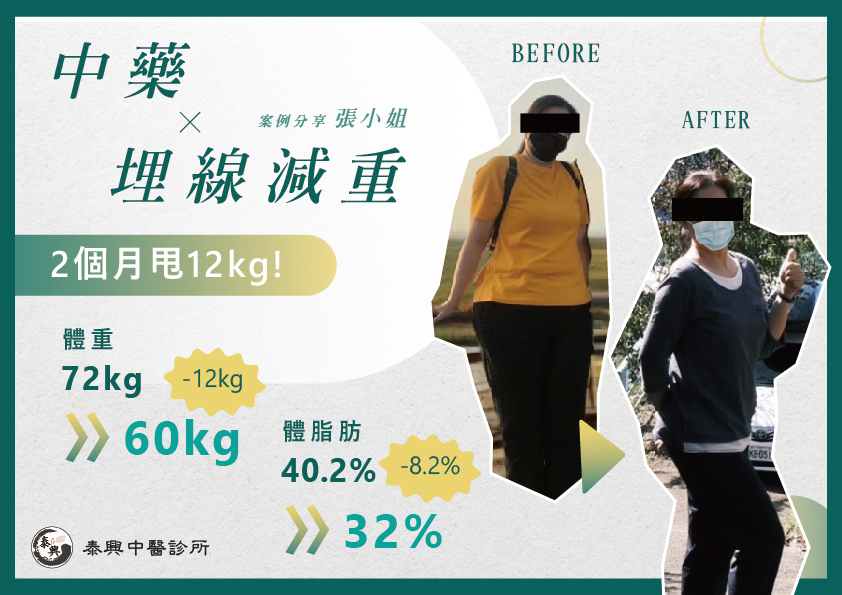 台北埋線減肥