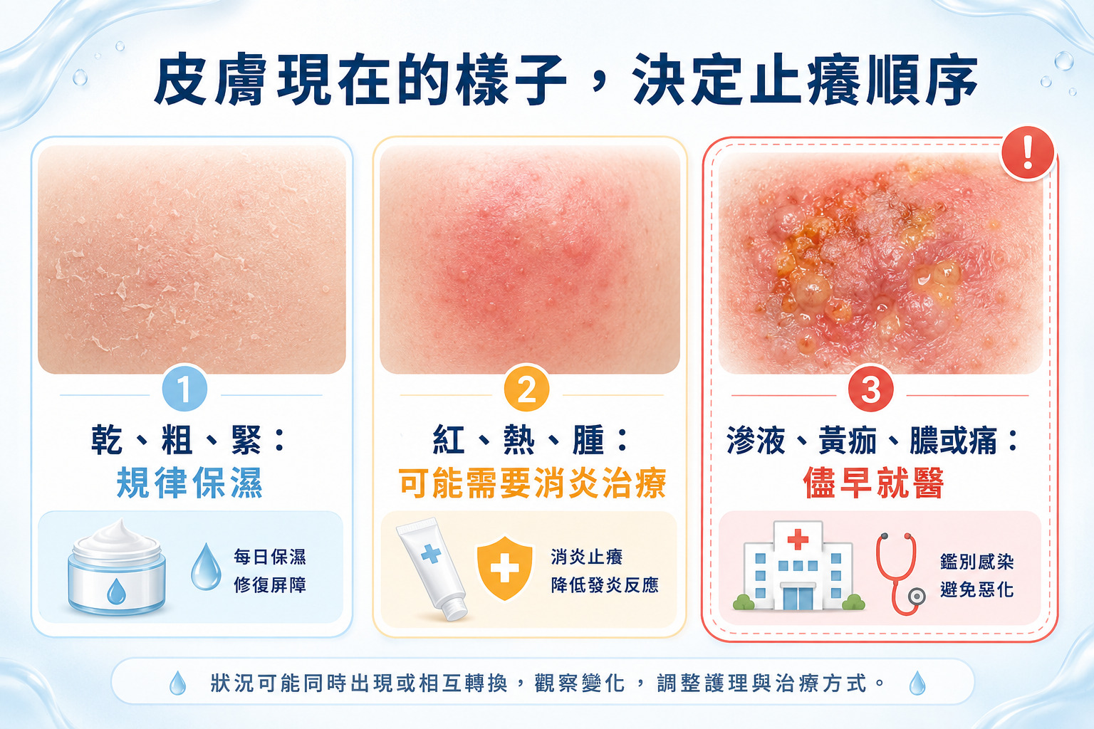 濕疹止癢方法